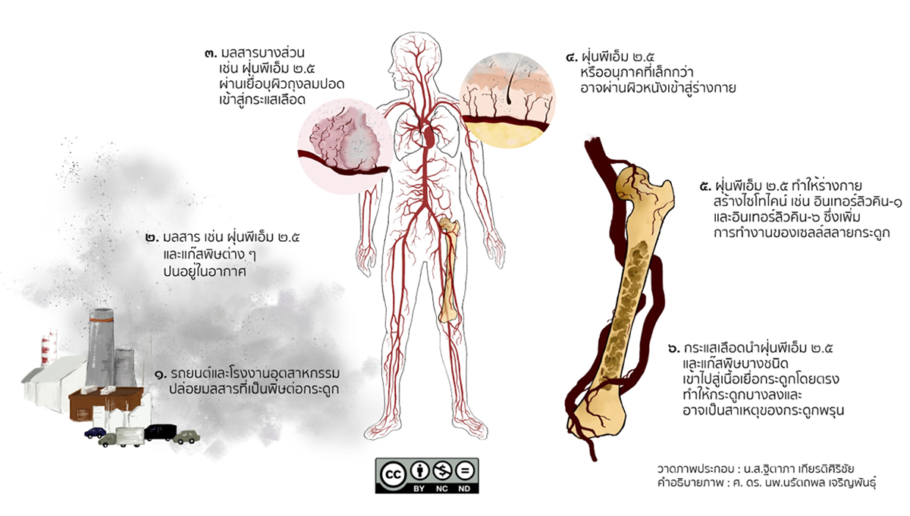 โรคกระดูกพรุน